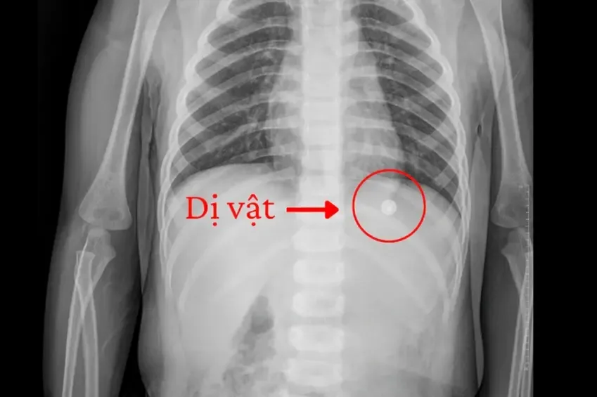 Hình ảnh dị vật qua X-quang